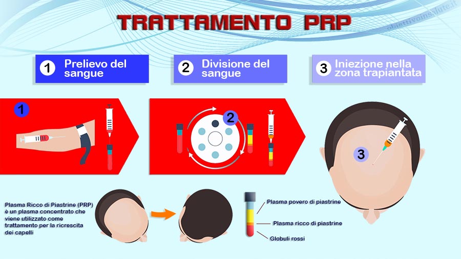 Trattamento PRP